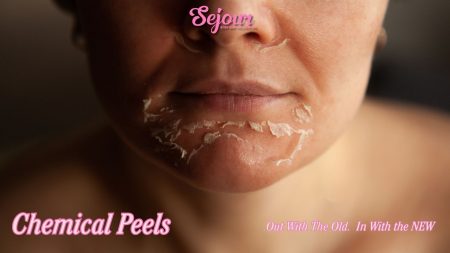 Chemical Peel Chemical Peel