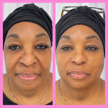 Facial Balancing Facial Balancing